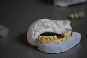 Видове пародонтоза 20 от MedicalDent Видове пародонтоза 20