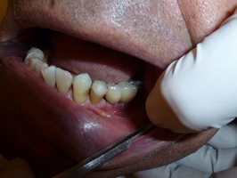 Намерете най-добрите оферти за пародонтоза 3 от MedicalDent Намерете най-добрите оферти за пародонтоза 3