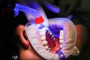 Типове пародонтоза 34 от MedicalDent Типове пародонтоза 34