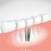зъбен мост - 32801 - разгледайте нашите предложения за