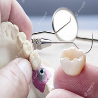 поставяне на зъбни импланти - 4097 предложения