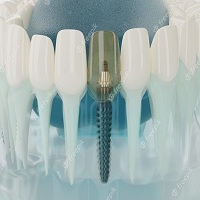 поставяне на зъбни импланти - 93101 възможности