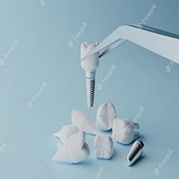 поставяне на зъбни импланти - 86321 отстъпки