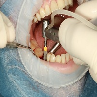 поставяне на зъбни импланти - 1632 типа
