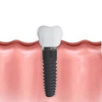 поставяне на зъбни импланти - 38474 цени