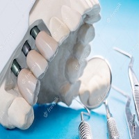 поставяне на зъбни импланти - 33019 постижения