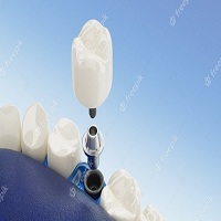 поставяне на зъбни импланти - 8290 бестселъри