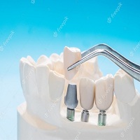 поставяне на зъбни импланти - 70215 отстъпки