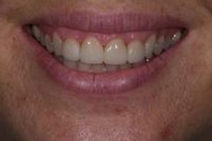 скърцане със зъби - 51553 цени | Supreme Dental скърцане със зъби - 18078 цени