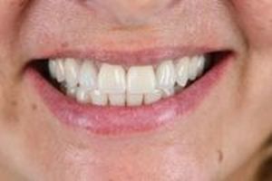 зъбни фасети - 86800 варианти