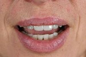 зъбни импланти - 67066 новини